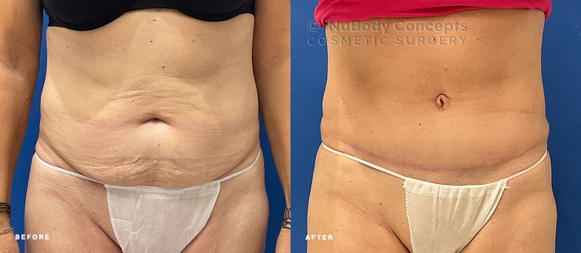 Tummy tuck before and after picture of NuBody Concepts Nashville patient by Dr Rosdeutscher - front