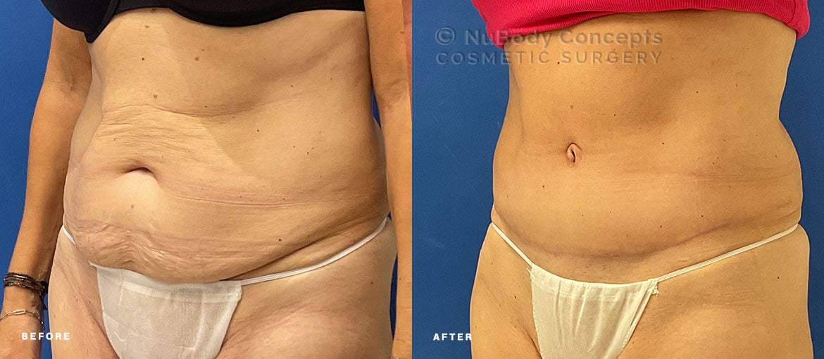 Tummy tuck before and after picture of NuBody Concepts Nashville patient by Dr Rosdeutscher - oblique
