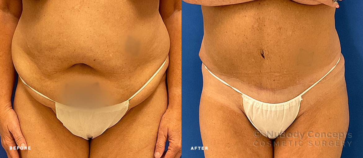 Tummy tuck before and after picture of NuBody Concepts Nashville patient by Dr Rosdeutscher - front