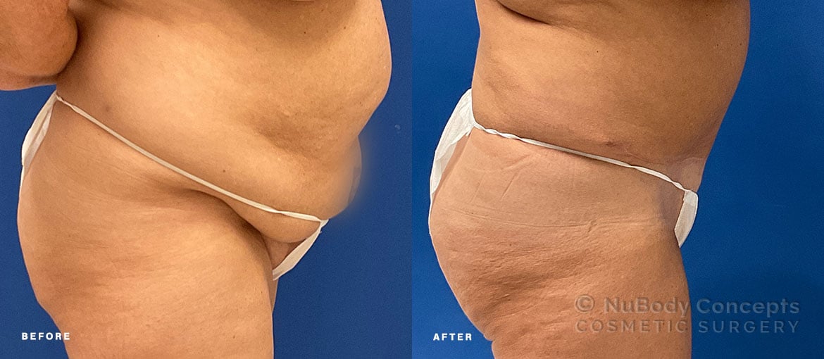 Tummy tuck before and after picture of NuBody Concepts Nashville patient by Dr Rosdeutscher - side