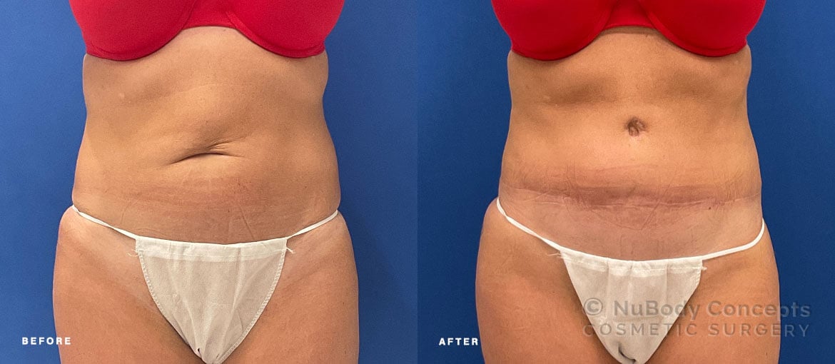NuBody Concepts Nashville tummy tuck patient before and 6 months after procedure