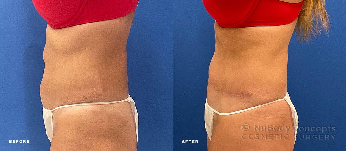 NuBody Concepts Nashville tummy tuck patient before and 6 months after procedure