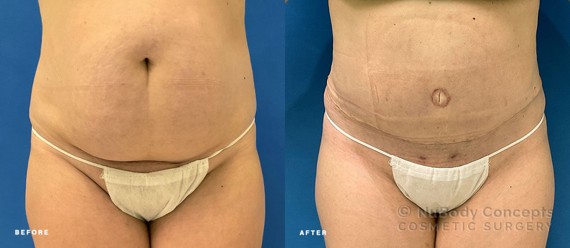 NuBody Concepts Nashville tummy tuck patient before and 1 month after procedure (front view)