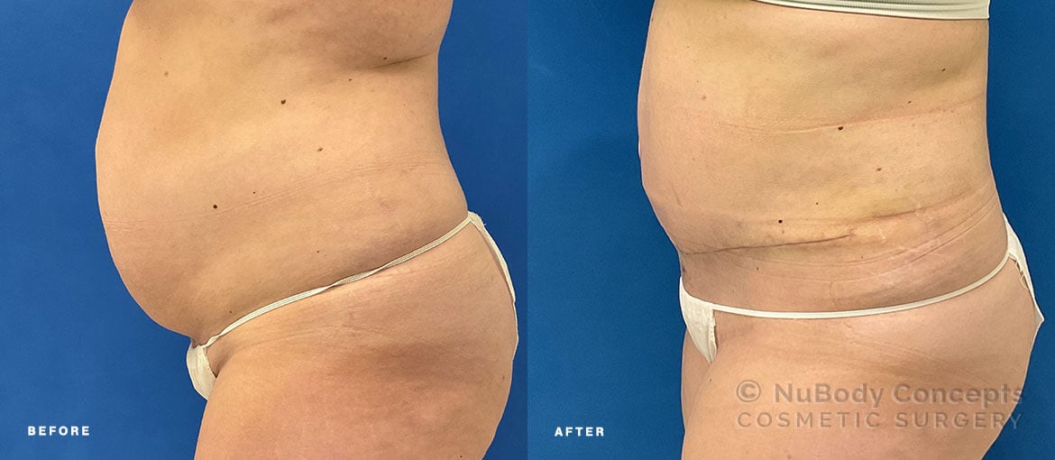 NuBody Concepts Nashville tummy tuck patient before and 1 month after procedure (side view)