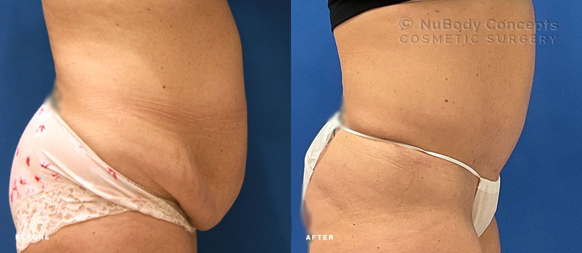 NuBody Concepts Nashville patient before and 12 months after tummy tuck surgery by Dr John Rosdeutscher