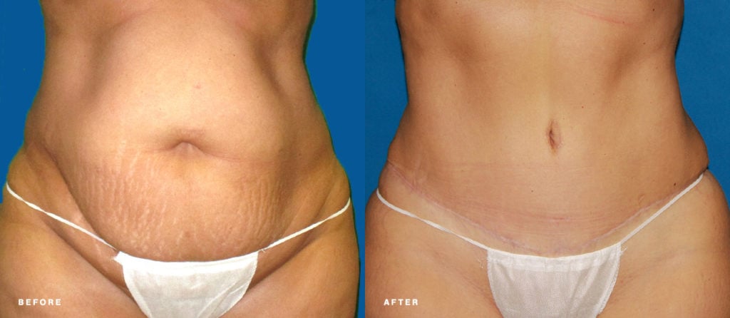 Tummy tuck before and after picture of NuBody Concepts patient