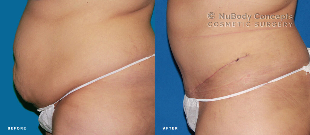 Tummy tuck before and after picture of NuBody Concepts patient