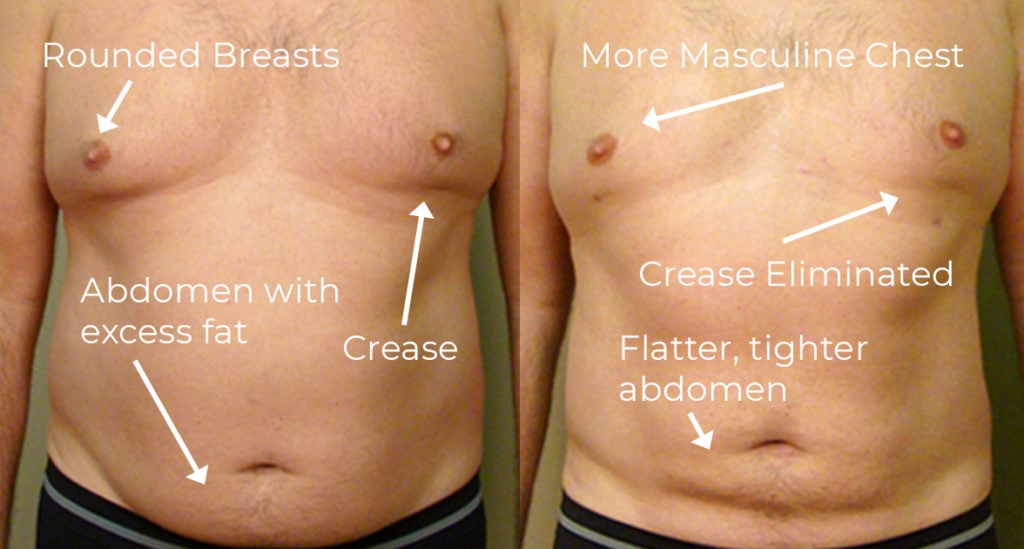NuBody Concepts patient before and after male breast reduction using liposuction
