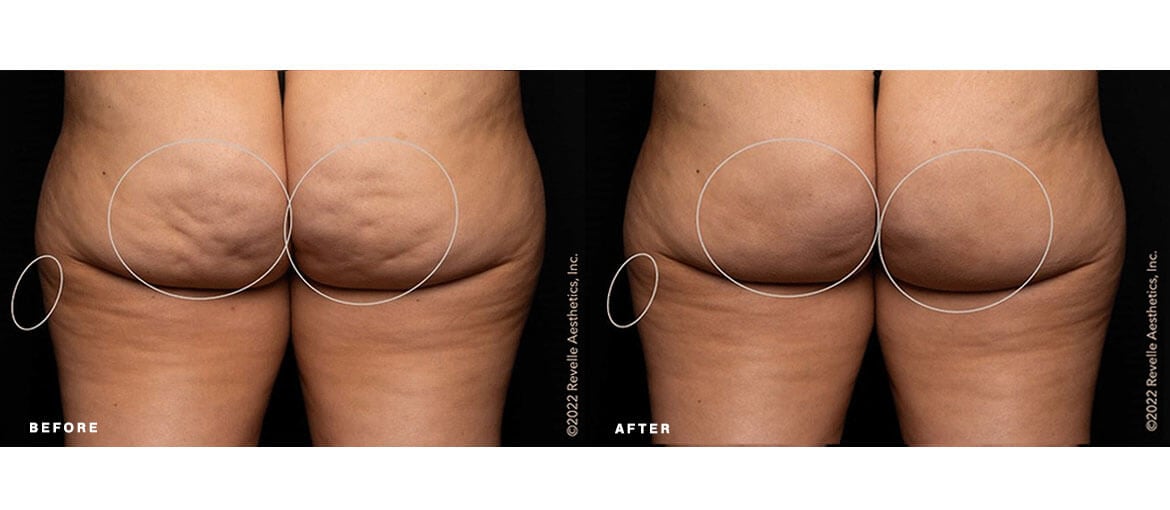 Cellulite reduction with Aveli before and 3 months after treatment