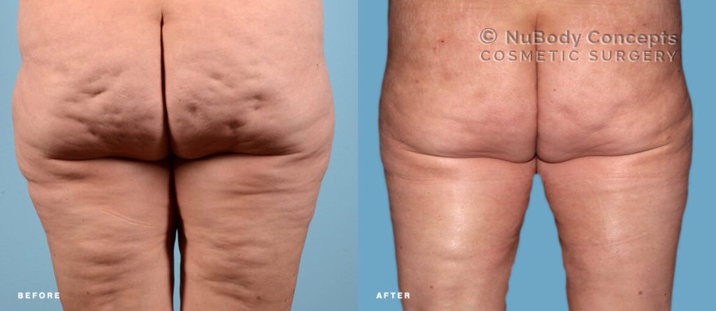 Patient with cellulite on buttocks before and after BodyTite treatment at NuBody Concepts