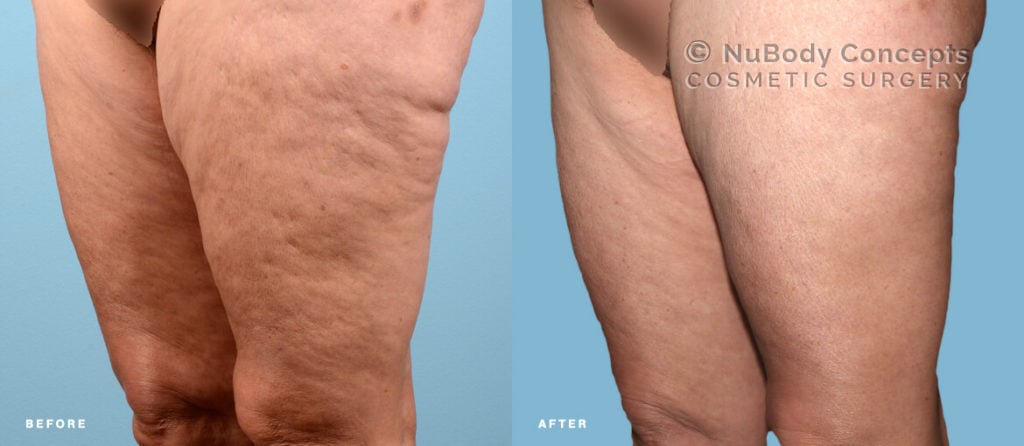 Patient with cellulite on thighs before and after BodyTite treatment at NuBody Concepts