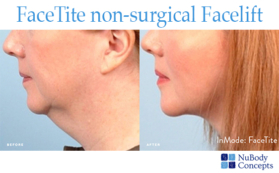 NuBody Concepts FaceTite non-surgical face lift before and after
