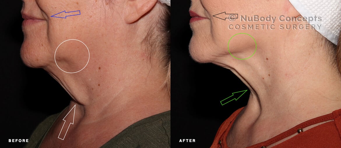 Facetite before and after picture of NuBody Concepts patient