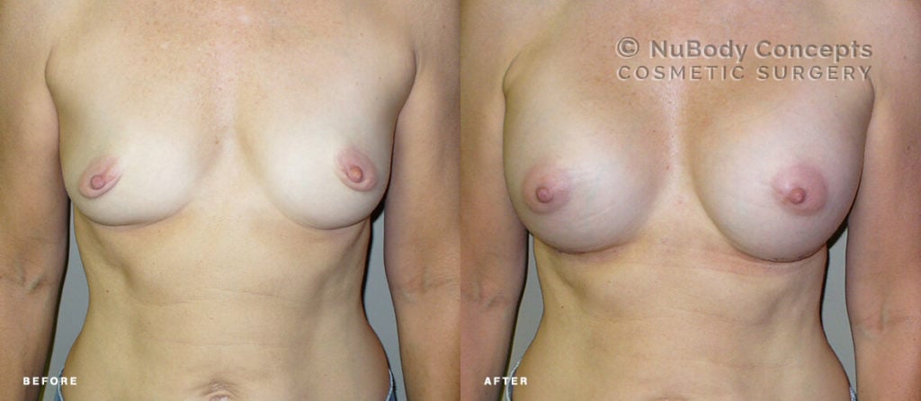 Breast implants silicone before and after picture of NuBody Concepts patient