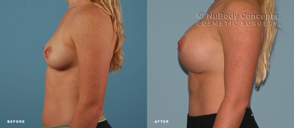 Breast implants silicone before and after picture of NuBody Concepts patient