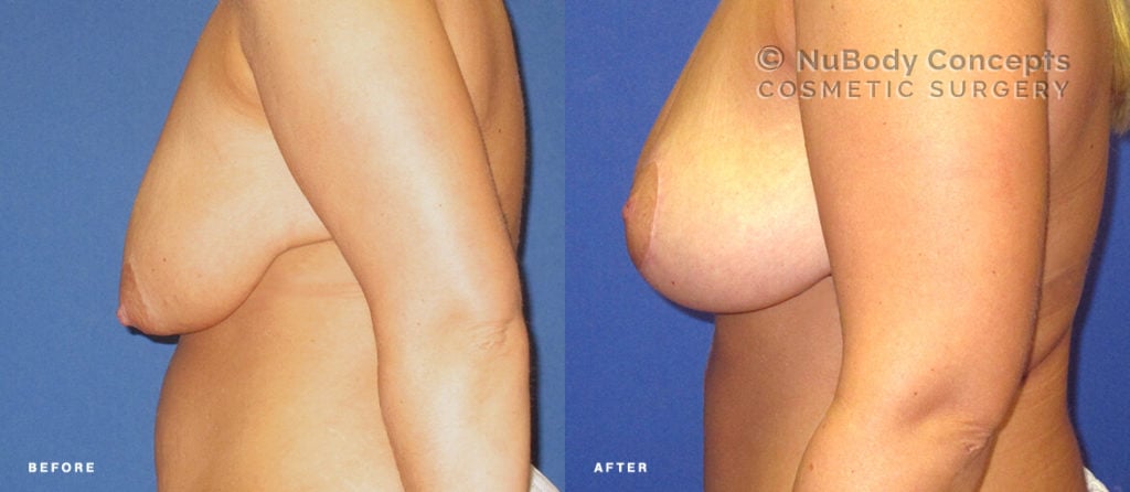 Breast lift before and after picture of NuBody Concepts patient