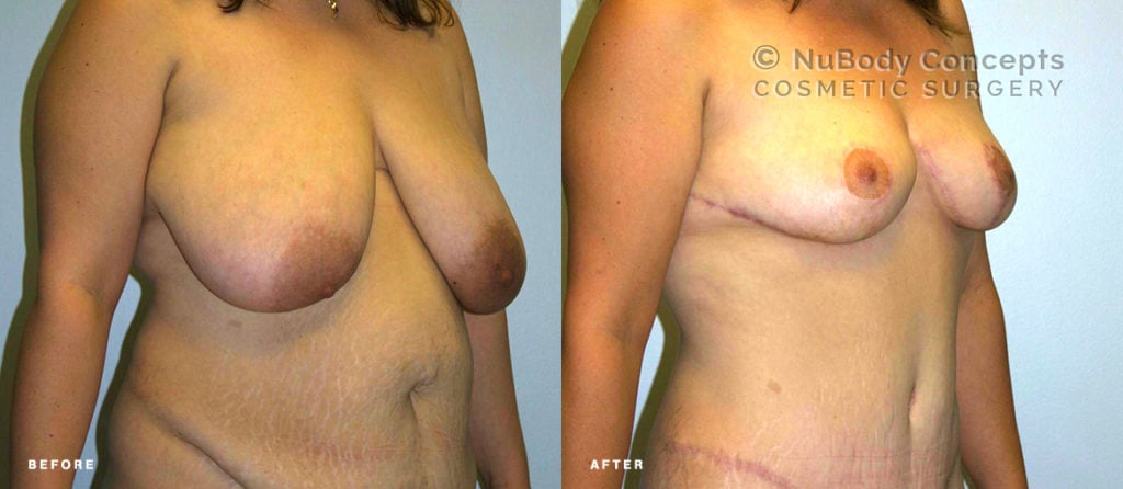 Mommy makeover before and after picture of NuBody Concepts patient