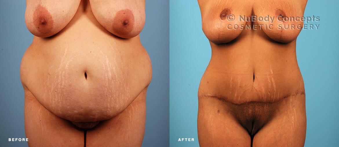 Mommy makeover before and after picture of NuBody Concepts patient