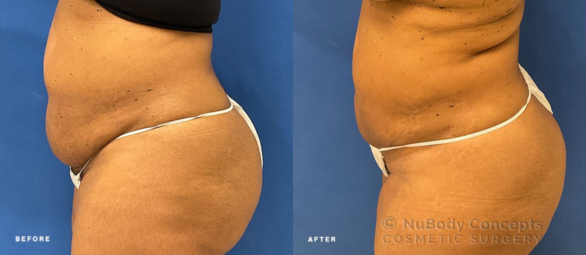 Renuvion skin tightening before and after picture of NuBody Concepts Nashville patient (side view)