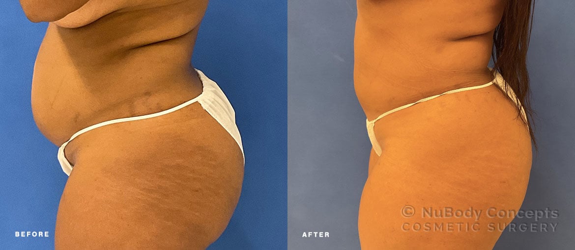 NuBody Concepts Nashville Renuvion skin tightening patient 12 months after procedure