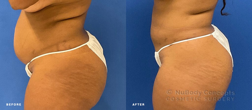 NuBody Concepts Nashville Renuvion skin tightening patient 3 months after procedure