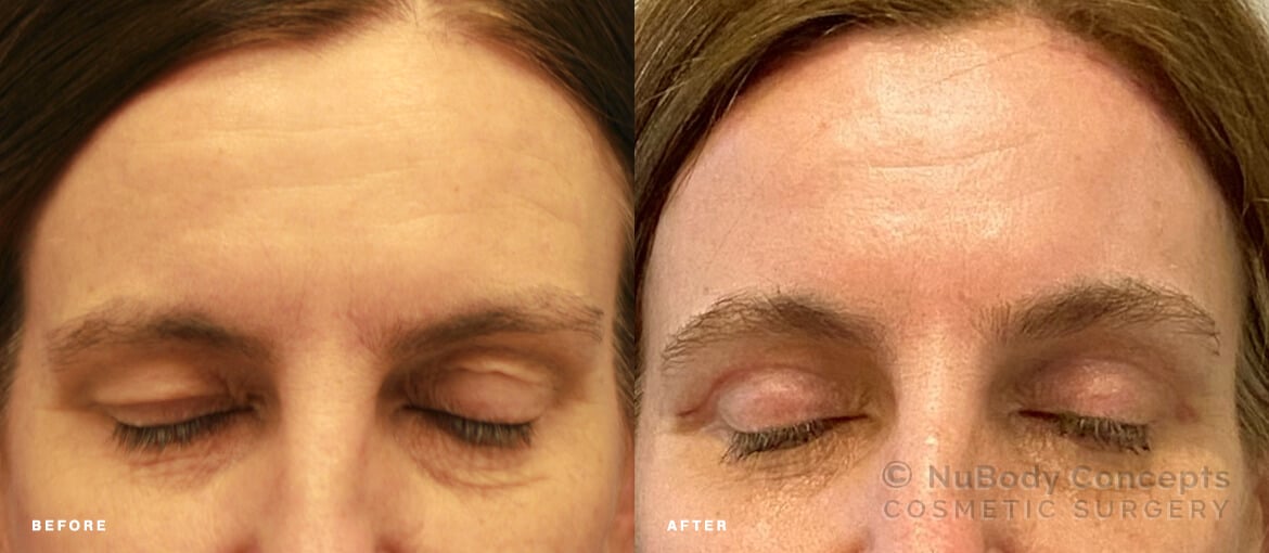 NuBody Concepts eyelid and brow lift surgery patient before and after picture 3 weeks - front view closed eyes
