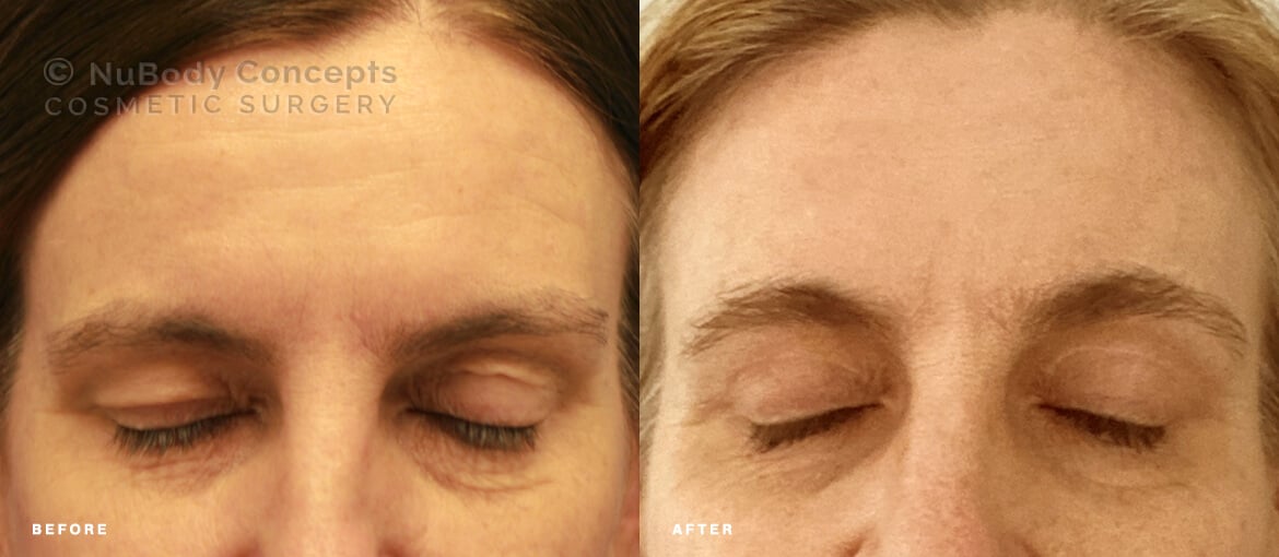 NuBody Concepts eyelid and brow lift surgery patient before and after picture 4 months - front view