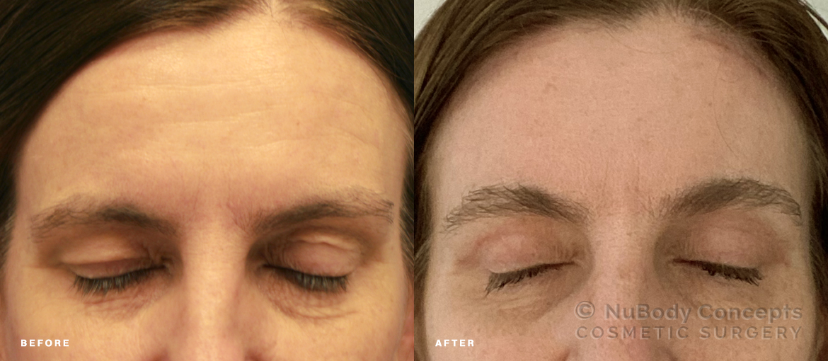 NuBody Concepts eyelid and brow lift surgery patient before and after picture 6 weeks - front view