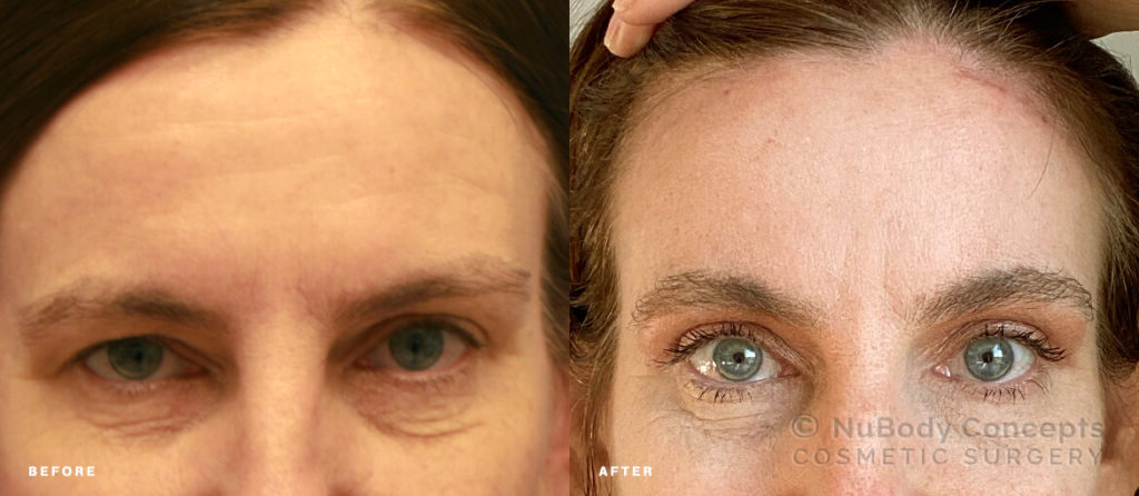 NuBody Concepts eyelid and brow lift surgery patient before and after picture 6 weeks - front view