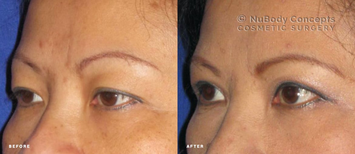 Upper eyelid surgery before and after picture of NuBody Concepts patient