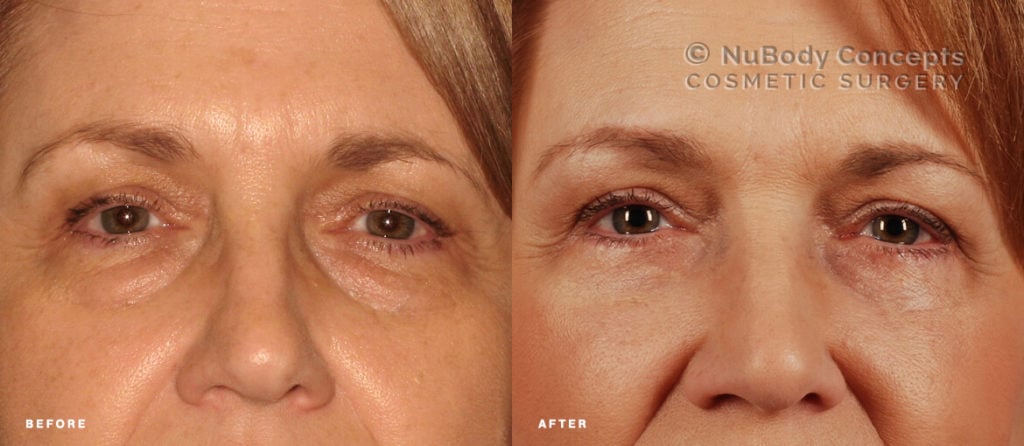 Lower eyelid surgery before and after picture of NuBody Concepts patient