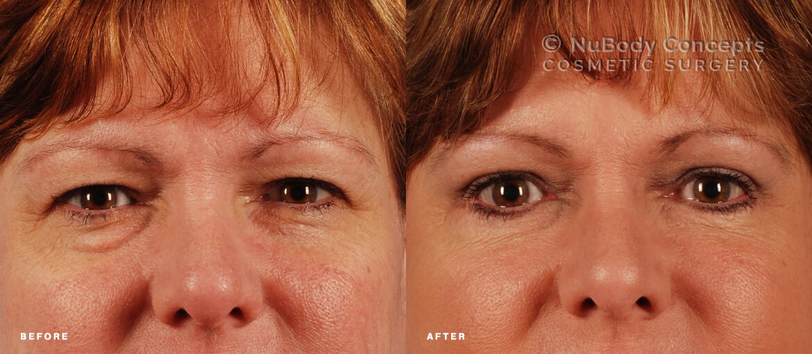 Lower and upper eyelid surgery before and after picture of NuBody Concepts patient