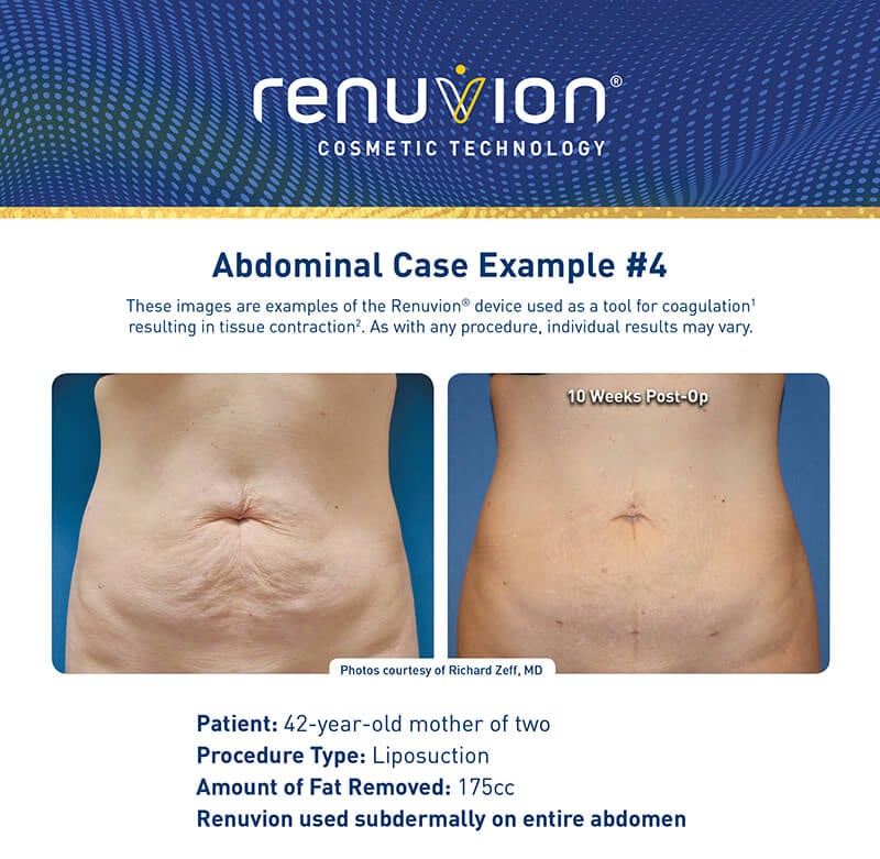 Renuvion skin tightening before and after picture - abdomen