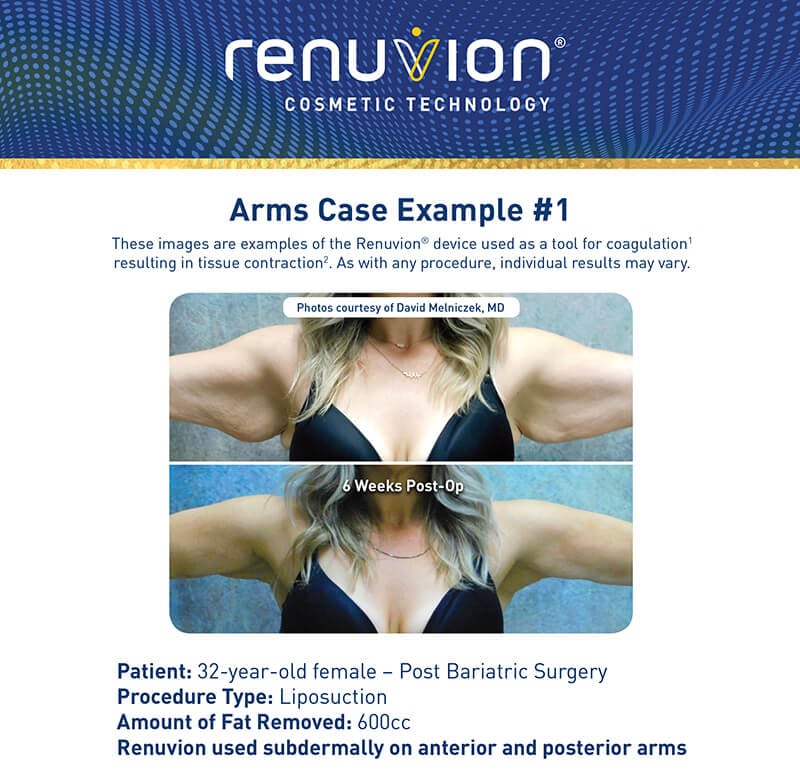 Renuvion skin tightening before and after picture - arms