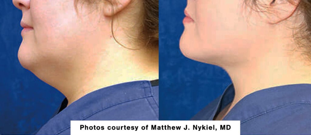 Renuvion skin tightening before and after picture - neck