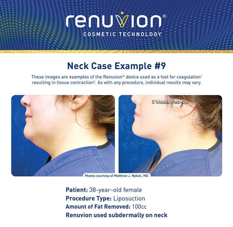 Renuvion skin tightening before and after picture - neck