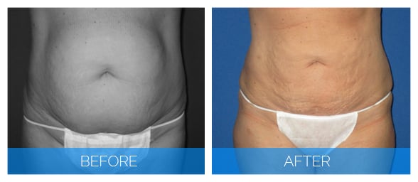 patient results on abdomen after liposuction without skin tightening