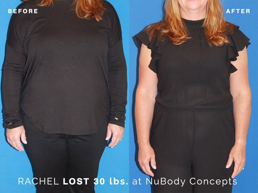 NuBody Concepts patient before and after her Orbera weight-loss balloon procedure