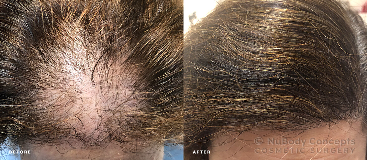NuBody Concepts Female Hair Restoration Before & After top view