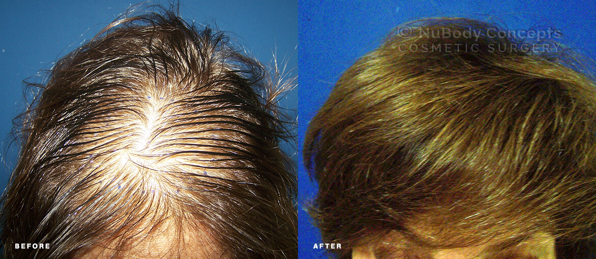 NuBody Concepts Female Hair Restoration Before & After front view