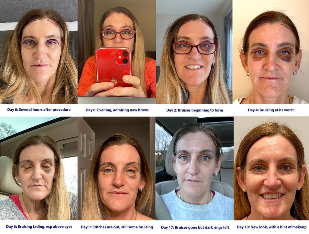 day by day recovery timeline of NuBody Concepts eyelid surgery patient