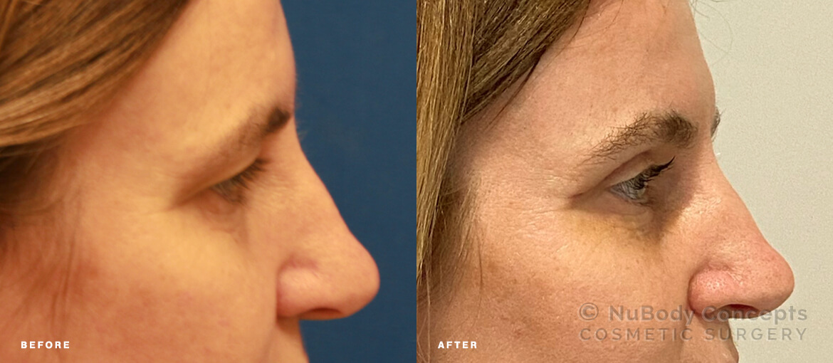 NuBody Concepts eyelid and brow lift surgery patient before and after picture 3 weeks - side view