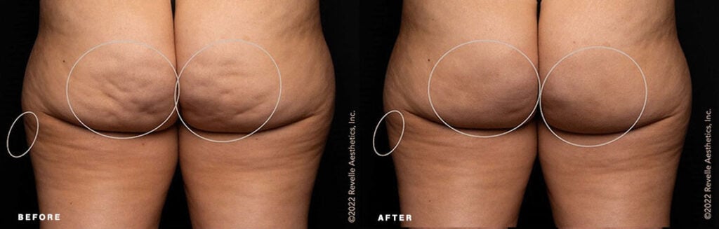 Aveli cellulite reduction before and after