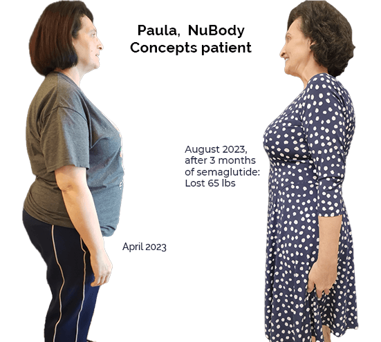 NuBody Concepts patient who lost 65 lbs with semaglutide weight-loss injections in 3 months