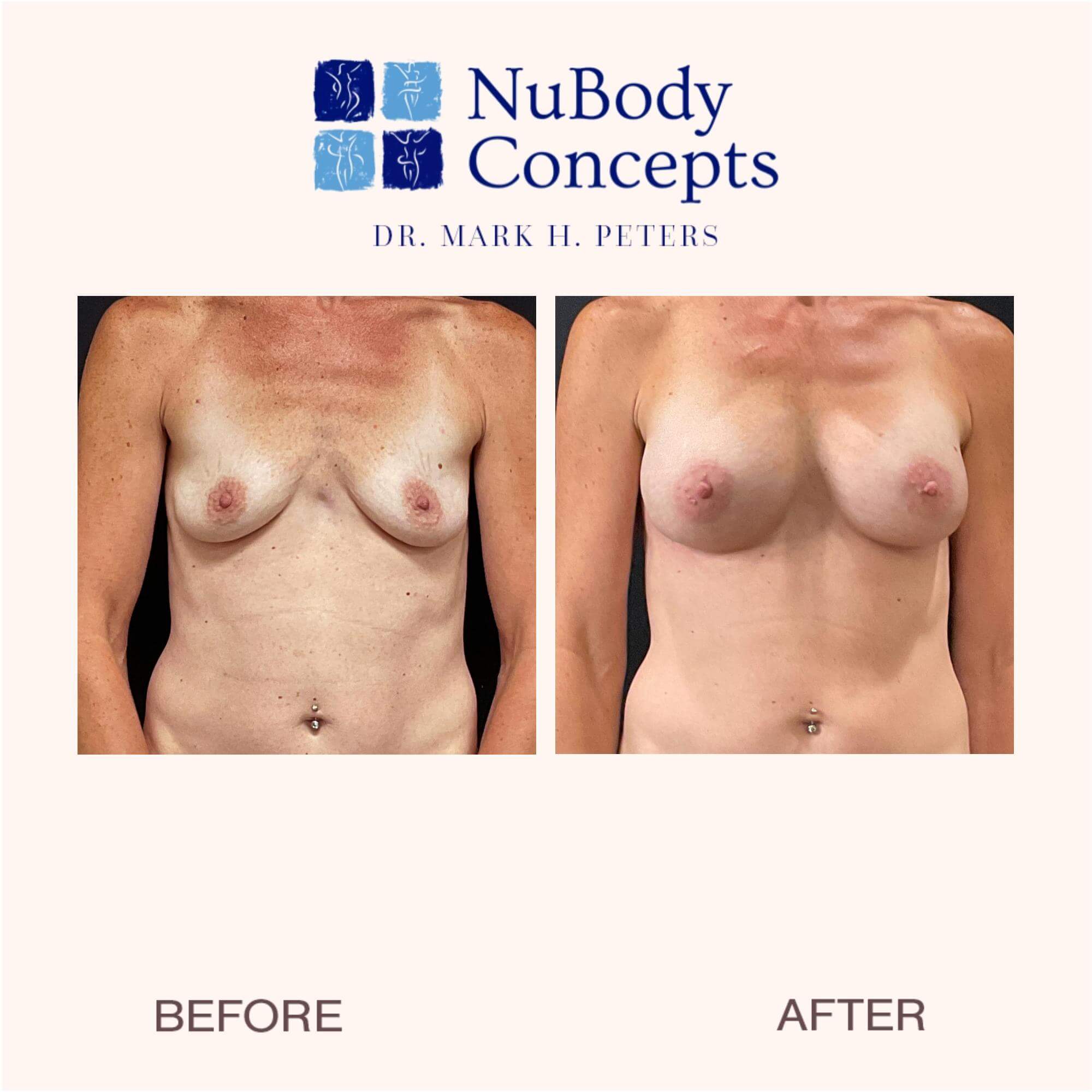 nubody concepts breast augmentation before and 6 months after procedure - front view