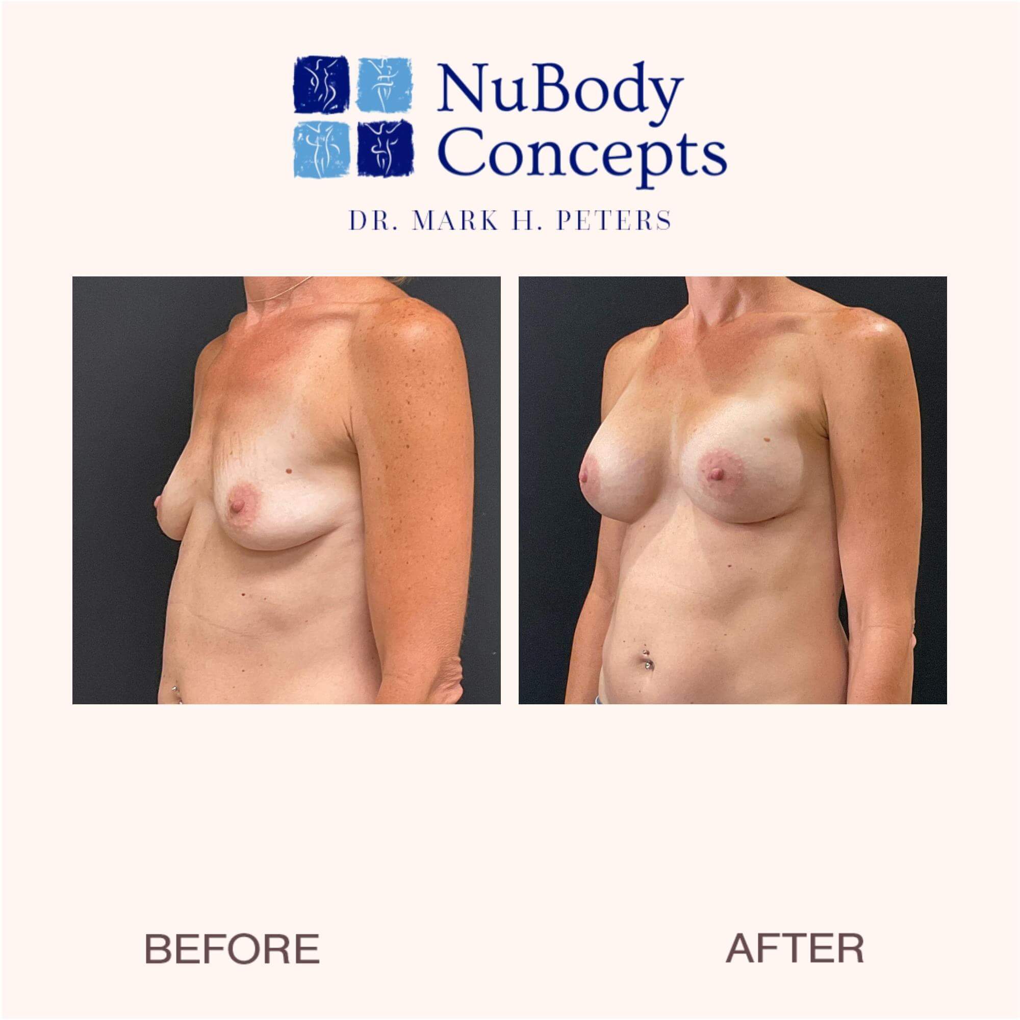 Before and after breast augmentation - right side view.