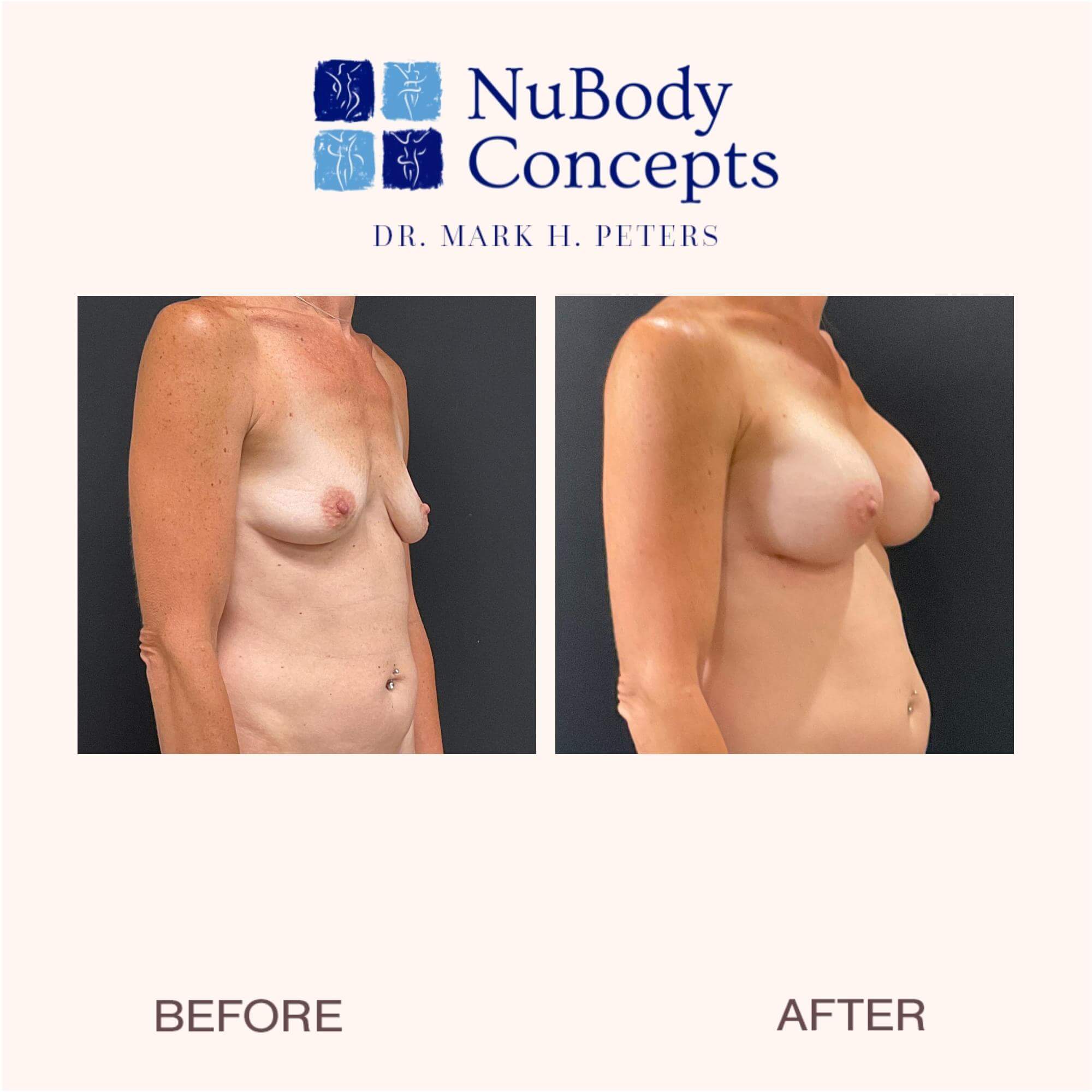 Before and after breast augmentation - left side view.