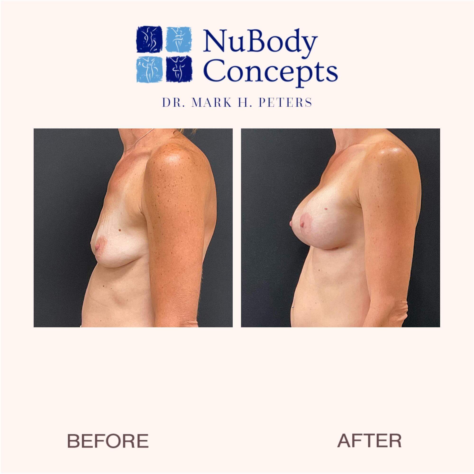 Before and after male breast reduction.