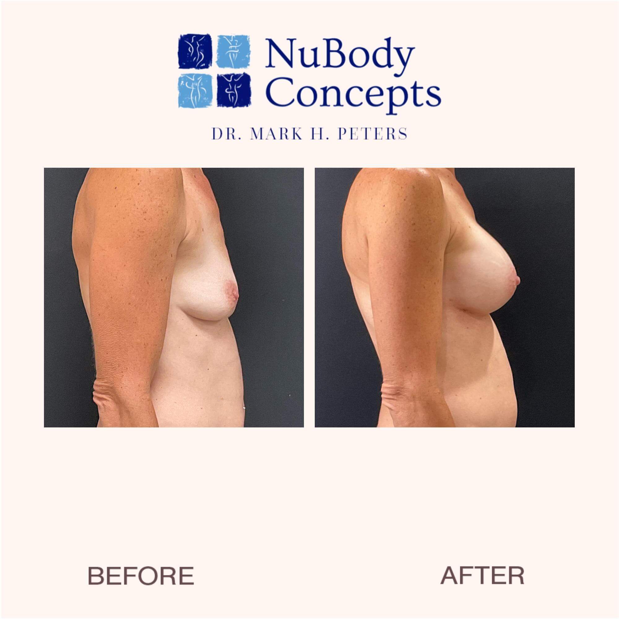 nubody concepts breast augmentation before and 6 months after procedure - right view