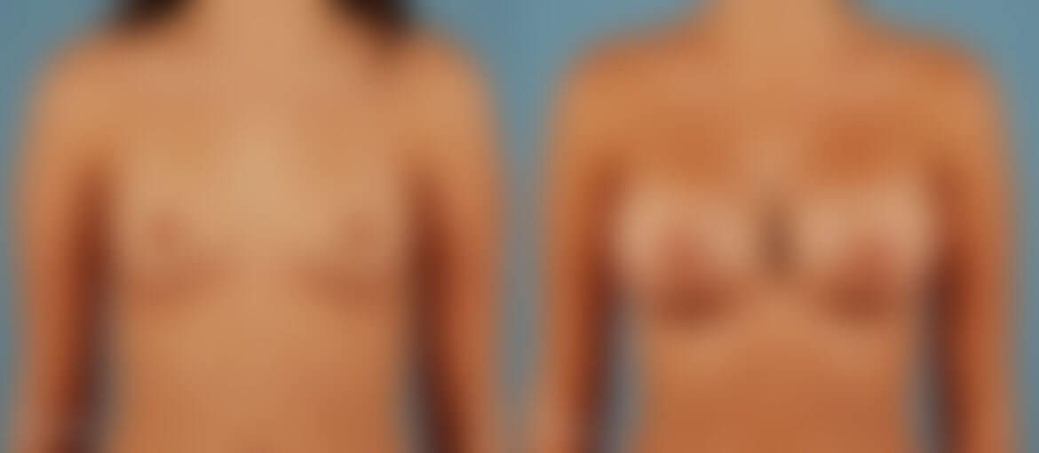 breast implants before and after blurred